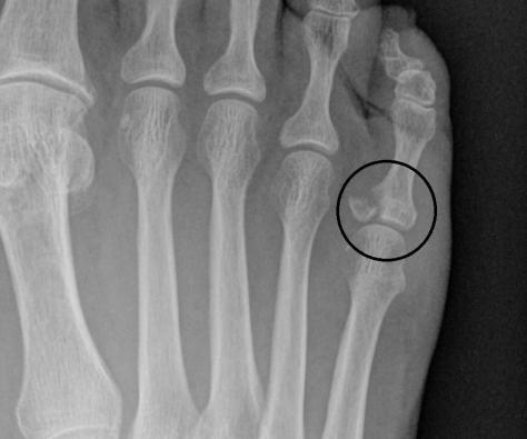 20992884_10212770999046247_36019243525522514_n brokenfoot